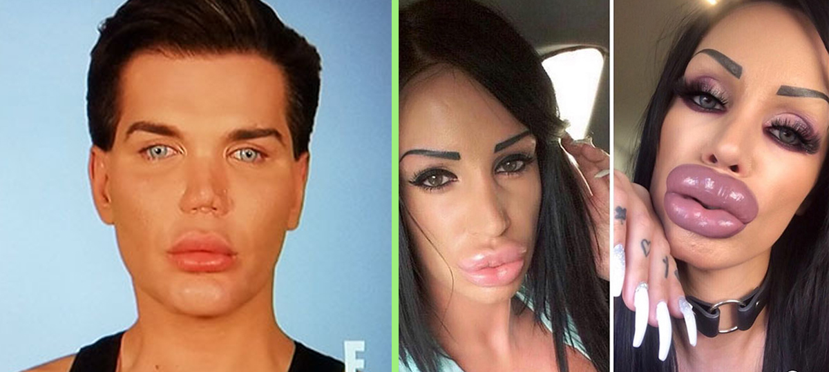 16 People Who Made All The Wrong Choices When It Came to Plastic Surgery